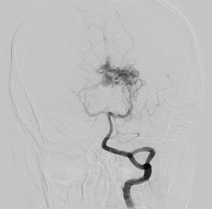 Digital subtraction angiography demonstrates classic arteriovenous malformation in the left thalamic region with drainage to the internal cerebral vein, Spetzler-Martin IIIb.