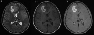 Brain MRI axial cuts: a. T2, b. T1 and c. T1+MC. Right frontal parasagittal cortical-subcortical intra-axial mass of intermediate signal intensity, with a blood component, not highlighted by the contrast media. Positive signs of compression with marked adjacent vasogenic edema, and a subfalcine hernia to the left. Shows a lesion in the left thalamic region with multiple flow voids forming a nest, associated with a vascular drainage structure related to an AVM, without signs of rupture or mass effect.