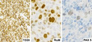 Marcadores inmunohistoquímicos positivos para CD20, PAX5 y MUM1, característicos de linaje de células B encontrados en LDCBG.