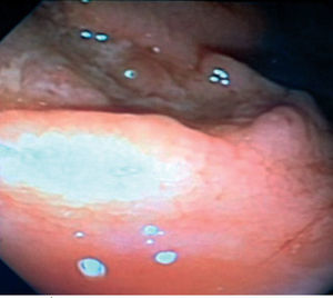 Úlcera en colon ascendente, con bordes mal definidos y centro deprimido, cubierta por fibrina.