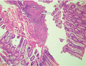 Tinción hematoxilina-eosina en biopsia de la lesión; se evidencia presencia de granulomas en el corte.