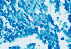 Tinción de Ziehl-Neelsen de tejido lesionar con evidencia de bacilos ácido alcohol resistentes.