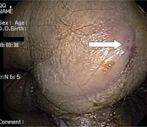 Región perianal; adviértase la presencia de una fístula perianal.