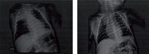 Imagen de radiografías de tórax practicadas a la paciente durante su hospitalización. Se aprecia atelectasia apical derecha.