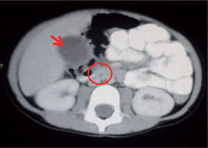 Tomografía axial computarizada abdominal donde se evidencia dilatación de la vesícula biliar y edema de la pared (flecha) y dilatación del colédoco con cálculo de 3mm en su interior (círculo).