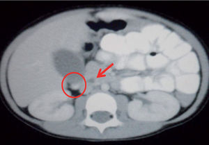 Tomografía axial computarizada abdominal donde se evidencia dilatación proximal del colédoco (flecha) y un cúmulo de microcálculos en zona declive de la vesícula biliar (círculo) dilatada y con engrosamiento de sus paredes.