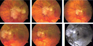 Fotografías del nervio óptico del ojo izquierdo con diferentes magnificaciones, donde se muestran hemorragias intrarretinianas peripapilares, nervio óptico edematizado con lesiones blancas, puntiformes y perladas