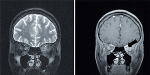 Proyección coronal de resonancia magnética cerebral que muestra aumento de la captación del contraste por el nervio óptico izquierdo (flecha negra), así como de la grasa que lo rodea