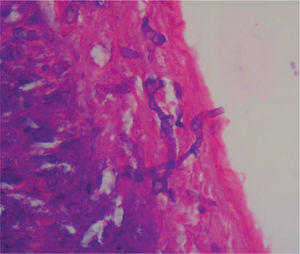 Biopsia de pared intestinal (40X). Tinción hematoxilinaeosina; se observa en la serosa presencia de hifas anchas predominantemente sin septos, algunos clamidosporos y ramificaciones no dicotómicas en ángulo recto.