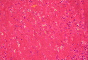 Histiocitos con presencia de hemozoína. Tinción de hematoxilina eosina (40×).