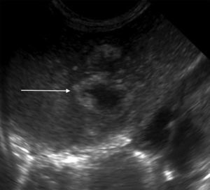 Abodminal ultrasound. Multiple focal, confluent, echogenic lesions, in segments IVA and VIII, with a thick echogenic wall and hypoechoic center, with a combined 29mm diameter, corresponding to the abscess (arrow); and a satellite lesion is visible (arrowhead), without an increased interior flow on echo doppler color.