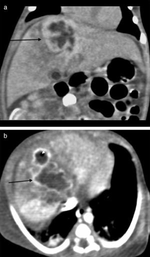 Abdominal scan with contrast. (A) Axial plane acquisition in portal phase: Focal lesion in segment VIII (arrow) with a 23mm×10mm diameter, hypodense liquid content with capsular highlighting and interior air (arrowhead) associated with adjacent hepatic parenchymal hypodensity due to altered perfusion. (B) Delayed coronal reconstruction which shows the thick capsule.