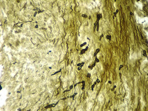 Biopsia de úlcera en carina en la que se observa en 40X la presencia de esporas e hifas septadas, ramificadas en ángulo agudo, compatibles con Aspergillus spp (tinción con plata metenamina).