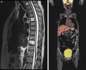 IRM contrastada de columna y PET-CT del caso 2. 2a. Corte sagital en T2 que muestra aumento en la intensidad de señal generalizada de los cuerpos vertebrales T1, T5 y T10 que presentan discreto realce con el medio de contraste. 2b. Numerosas adenomegalias a nivel laterocervical, mediastino, hiliar bilateral e inguinal izquierdo con leve actividad metabólica que varía entre 2 y 2,4 de SUV máximo.