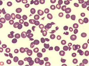 Abundantes esquistocitos, anisocitosis y presencia de hematíes con punteado basófilo. Ausencia de plaquetas.