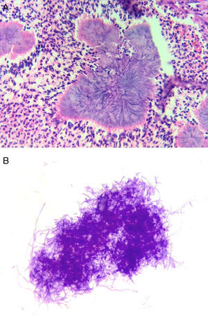 A) Coloración de hematoxilina-eosina del tejido de ovario y trompa uterina (40 x). B) Coloración de Gram de las colonias de Actinomyces recuperadas en agar sangre (100 x). Nótese la morfología de los bacilos grampositivos y el tipo de agrupación característica de este tipo de microorganismos.