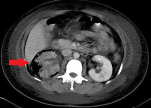 Pielonefritis enfisematosa. TAC de abdomen con contraste en la que se evidencia riñón derecho aumentado de tamaño, con presencia de gas pararrenal y destrucción del parénquima renal (flecha).