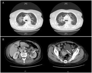 A) TC: infiltrados pulmonares bilaterales en vidrio deslustrado. B) Pionefrosis (flecha blanca izquierda) con dilatación ureteropielocalicial izquierda secundaria a litiasis en tercio distal del uréter (flecha blanca derecha).