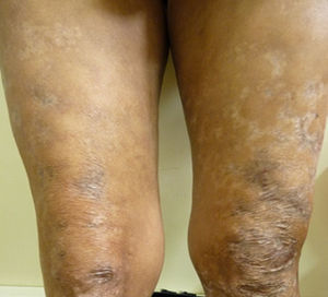 Scars of lesions in lower limbs after treatment.