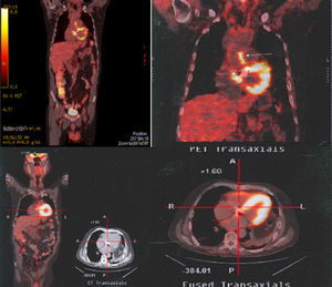 Arriba. Aumento focal anormal al momento del diagnóstico (09/02/2011) de la captación en los contornos de la raíz de la aorta ascendente inmediatamente encima del reemplazo valvular sugestivo de aortitis. Proceso inflamatorio/infeccioso de las paredes de la raíz de la aorta inmediatamente por encima del plano valvular. Abajo. Estudio normal sin cambios hipermetabólicos anormales. Tras 4 meses de antibioticoterapia (14/06/2011).