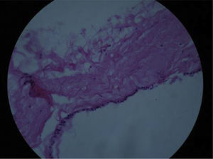 Corte histológico de la pared de un quiste con células cúbicas y cilíndricas.