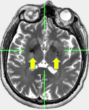 Axial MRI view of bilateral implantation of DBS into ventromedial globus pallidus is showed. Mean of coordinates (±SD) in mm were for right side (x=20.5±1.5, y=1.9±1.7, z=-3.5±0.5) for left side (x=19.7±1.1, y=2.6±1.8, z=-3.3±0.6). Arrows show location of leads in Gpi.