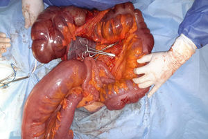 Evidence of trans-operative distension of the colon with cecum of 18cm in diameter. Small intestine normal.