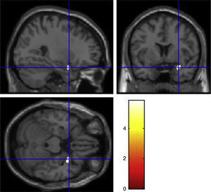 Decrease of grey matter concentration in right superior temporal pole (MNI coordinates xyz in mm=28.5, 6, −22.5) in violent-low activity allele group compared to control-low activity allele group.