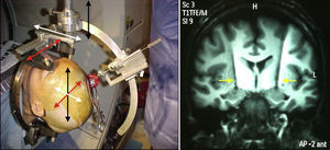 In this picture on left side it is showing a stereotactic procedure. The head of patient is fixed inside of Cartesian coordinates system (X: red, Y: black, Z: white) in order to localize a specific target through a burr hole in the skull. Prior the coordinates were found out by software that analyzed magnetic resonance and CT-scan images. Right side shows two electrodes into basal ganglia (yellow arrows).