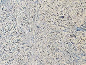 Storiform fibrosis associated to lymphoplasmacytic inflammatory infiltrate. 100× Masson staining.