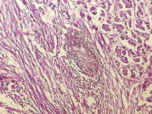 Pancreas with obliterative phlebitis. 100× elastic fibres staining.