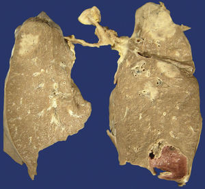 Lungs with nodular lesions in both upper lobes.