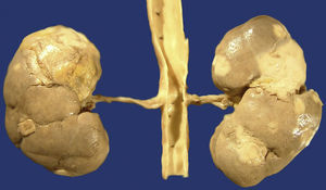 External surface of the kidneys that show light yellow nodules of cortical prevalence.