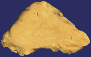 Submandibular gland replaced by light yellow tissue (Küttner tumour).