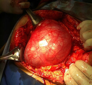 Giant ovarian cyst in middle line during exploratory laparotomy.