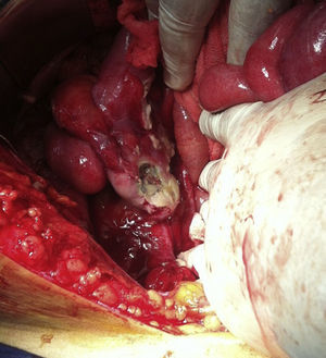 Caecal appendix with perforation in middle third.