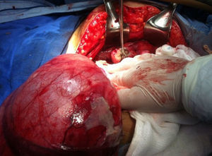 Partial view of eviscerated giant ovarian cyst and caecal appendix in right iliac fossa.