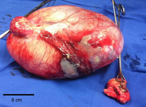 Surgical pieces: giant left ovarian cyst and caecal appendix with perforation in middle third.