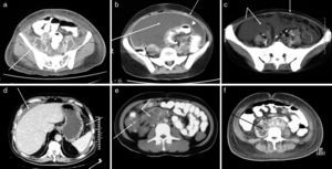 (a) Adenomegaly at the common iliac chains with hypodense nodes and hyperdense wall. (b) Thickening of the peritoneum, abundant ascites, thickening of the intestinal loop wall and evident lymphatic nodes. (c) Diffuse increase in the attenuation of the peritoneal fat. Calcified mesenteric lymph nodes of granulomatous aspect. (d) Ascites of perihepatic distribution, discreet increase of peripheral fat density and small nodules. (e) Important thickening of the blindgut wall, hypodense lymph nodes. Increased density in the mesenteric fat. (f) Wide hypodense retroperitoneal adenomegaly with well-defined precaval and paraaortic walls adjacent to the caeliac artery and portal hepatic region.