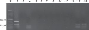 Representative image of a patient with LAL. Lane 1: Molecular weight marker; Lane 2: β-2-microglobulin (394 pb) and GAPDH (221 pb); Lane 3: BCR-ABL M (−); Lane 4: BCR-ABL m (150 pb); Lane 5: E2A-PBX1 (−); Lane 6: TEL-AML1 (−); Lane 7: AF4-MLL1 (−); Lane 8: PML-RARα (−); Lane 9: AML1-ETO (−); Lane10: MAGE-A3 (−); Lane 11: NY-ESO1 (−); Lane 12: ABC-B1 (201 pb); Lane13: ABC-G2 (206 pb).