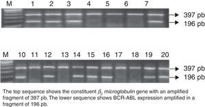 BCR-ABL expression in patients with ALL.