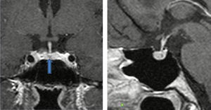 T1 weighted spin echo sequence with IV gadolinium in sagittal and coronal plane. Cold, 2.5mm lesion located in the centre of the anterior pituitary. Compatible with microadenoma.