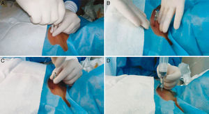 Sternal puncture (continued). (A) Introduce the needle by rotating it on its axis. (B) Continue until the needle is fixed in place. (C) Remove the stylet. (D) Draw the aspirate using a 20ml syringe. Only 1ml will be needed for the smear.