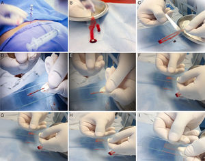 Preparing the bone marrow smear. (A) When the bone marrow aspiration needle is in place, use a 20ml syringe to draw 1ml of aspirate. (B) Place a few drops of aspirate on a slide held vertically to facilitate visualisation of the bone marrow spicules. (C) Using the edge of a second slide, separate and isolate a few bone marrow spicules from the rest of the sample. (D) Transfer these to a third slide. (E) Without applying pressure, distribute the spicules in the centre of the slide. (F) Place the second slide across the third slide to form a cross with the spicules in the centre. (G) Gently but quickly slide the second slide over the third slide to extend the spicules along its length. (H) Make sure the aspirate is spread evenly over the entire slide. (I) Allow to dry for 5min, and then send it to the lab for tincture.