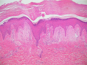 Fissured eosinophilic masses in the papillary dermis, solar elastosis and a Grenz zone of elastin fibres. 40× haematoxylin and eosin stain.