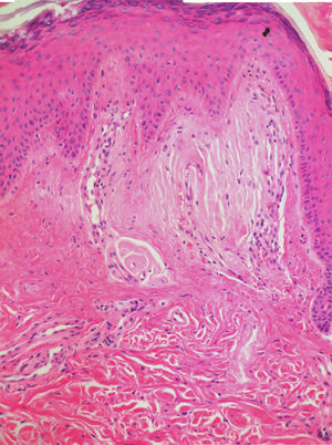 Fissured eosinophilic masses in the papillary dermis. 100× haematoxylin and eosin stain.