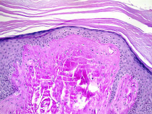 Fissured eosinophilic masses. 100× crystal violet.