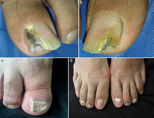 Clinical forms of onychomycosis. (a) Lateral subungual onychomycosis (LSO). (b) Distal subungual onychomycosis (DSO). (c) Total dystrophic onychomycosis (TDO). (d) Proximal subungual onychomycosis (PSO).