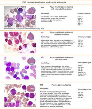 French-American-British (FAB) classification of acute myeloblastic leukaemia. FAB classification of acute myeloblastic leukaemia.