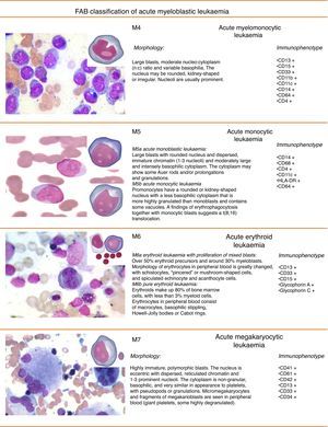 French-American-British (FAB) classification of acute myeloblastic leukaemia (continued).